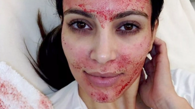 El tratamiento que usó Kim Kardashian El tratamiento que usó Kim Kardashian