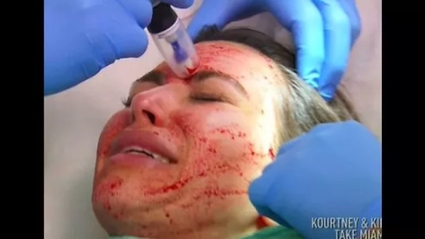 El tratamiento que usó Kim Kardashian El tratamiento que usó Kim Kardashian